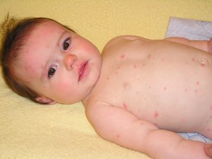 Relieve From Chicken Pox Itching