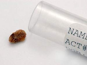 Get Rid Of Kidney Stones From Herb