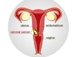 Study Confirms Hpv Vaccine Prevents Cervical Cancer In Women