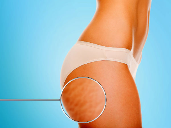 ಚರ್ಮದ ಗುಳಿಗಳನ್ನು ನಿವಾರಿಸಲು (Cellulite)