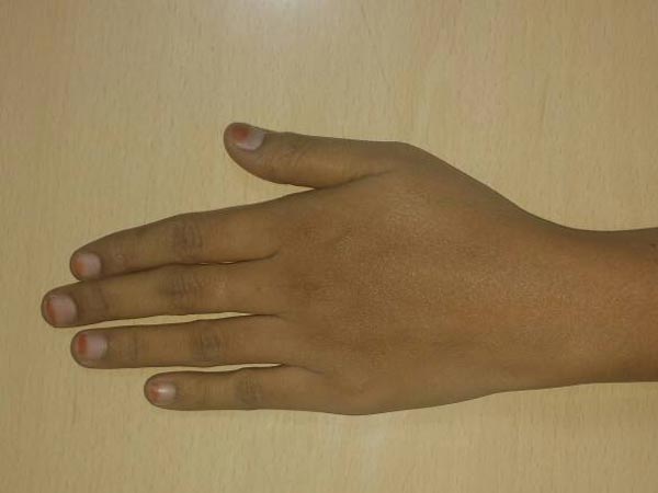 ಎಡ ಶಂಖಾಕೃತಿಯ ಅಚ್ಚು (The Ulnar Loop)