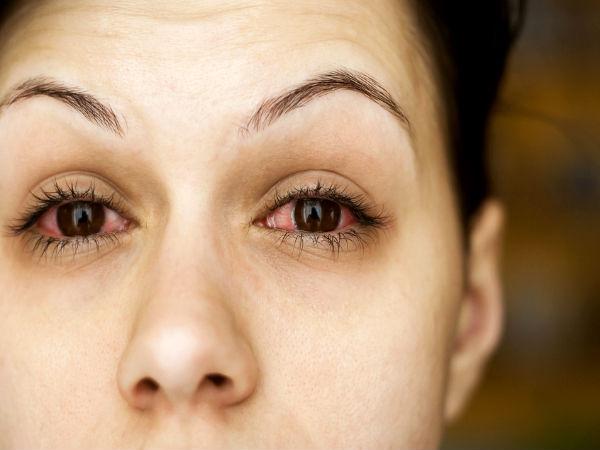 ಒಣ ಕಣ್ಣುಗಳ ಲಕ್ಷಣ (Dry Eye Syndrome)