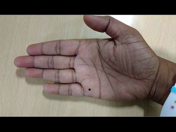 ಮದುವೆ ಗೆರೆಯಲ್ಲಿ ಮಚ್ಚೆ