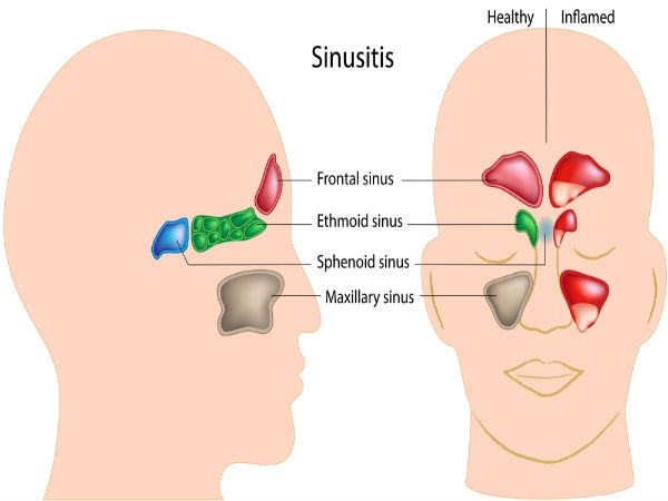 ಏನಿದು ಸೈನಸ್ ಸೋಂಕು? (Sinus infection)