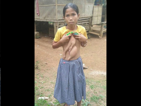 ಪರಾವಲಂಬಿ ಅವಳಿಯು ಬೆಳೆಯುತ್ತಲಿದೆ