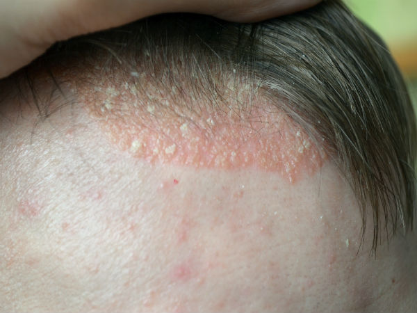 ನೆತ್ತಿ (Scalp (tinea capitis)