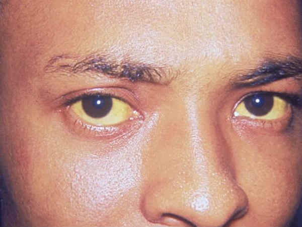 ಕಾಮಾಲೆ (Jaundice)