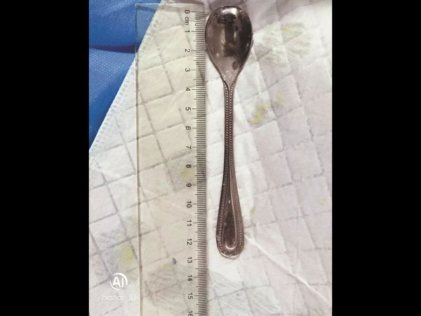 ನಾಲ್ಕು ದಿನಗಳ ಕಾಲ ಚಮಚವು ಆಕೆಯ ದೇಹದೊಳಗೆ ಇತ್ತು