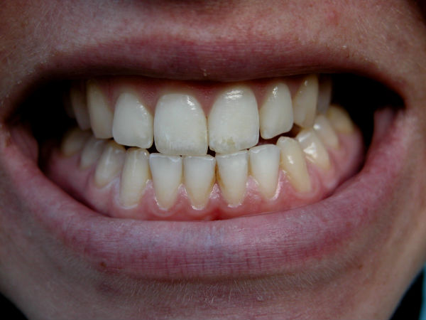 ಪೀರಿಯೋಡಾಂಟಿಸ್ (Periodontitis)