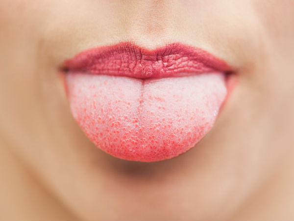 ನಾಲಿಗೆಯಲ್ಲಿ ಕಪ್ಪು ಕೂದಲು (Black Hairy Tongue)