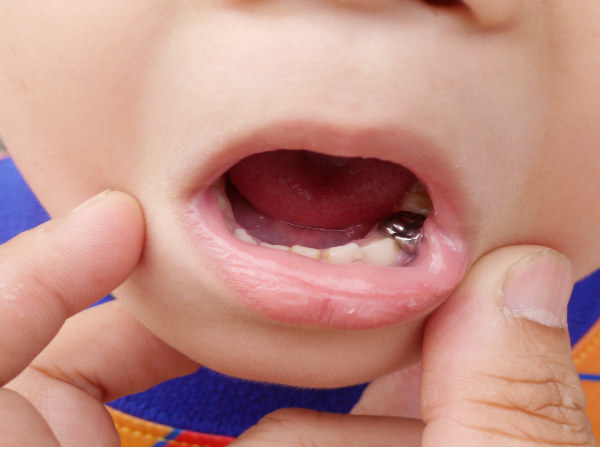 ಭೂಪಟದಂತಹ ನಾಲಿಗೆ (Geographic Tongue)