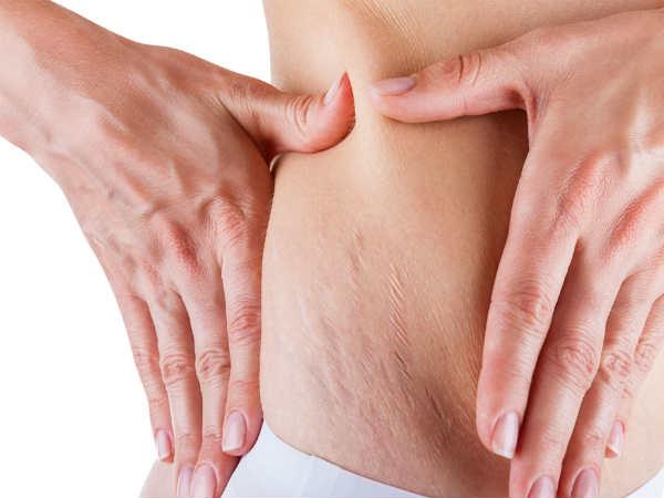 3. ಪಿಯುಪಿಪಿಪಿ (Pruritic urticarial papules and plaques of pregnancy (PUPPP))