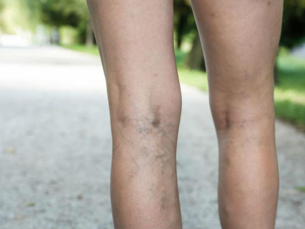 10. ನರಗೊಳಗೆ ರಕ್ತ ಹೆಪ್ಪುಗಟ್ಟುವುದು (Deep Vein Thrombosis)