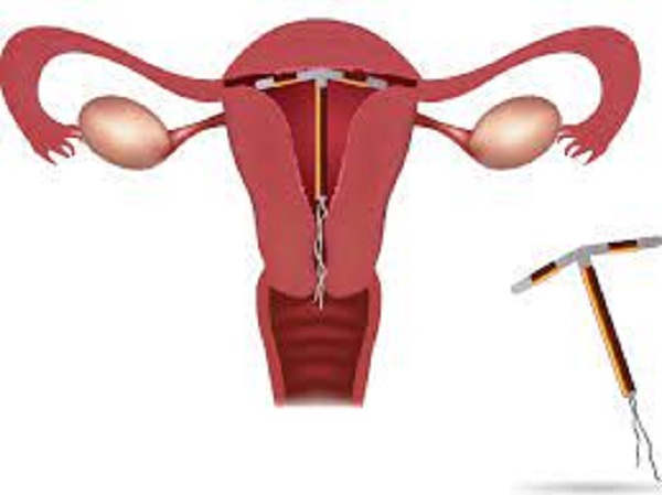 ಇಂಪ್ಲ್ಯಾಂಟ್ಸ್ ಹಾಗೂ IUD ನಡುವಿನ ವ್ಯತ್ಯಾಸವೇನು?