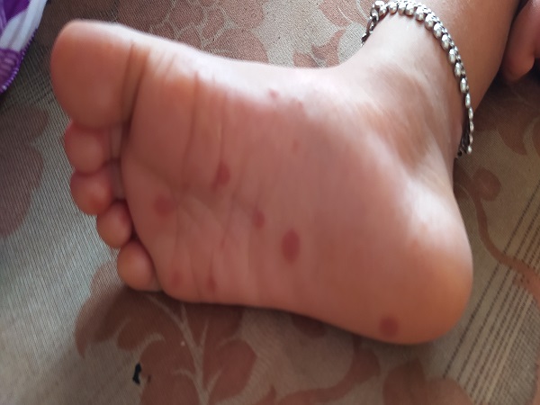 ಟೊಮೆಟೊ ಜ್ವರದ ಲಕ್ಷಣಗಳು