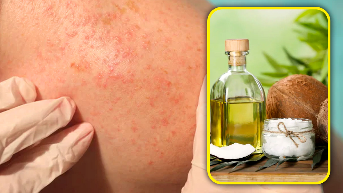 ಬೆವರು ಕಜ್ಜಿ, ಸನ್‌ ಬರ್ನ್‌ ಮುಂತಾದ ಬೇಸಿಗೆಯ ತ್ವಚೆ ಸಮಸ್ಯೆಗೆ ತೆಂಗಿನೆಣ್ಣೆ