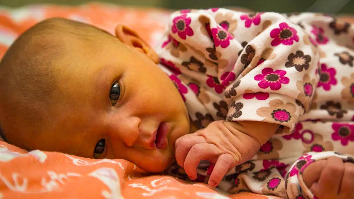 ನವಜಾತ ಶಿಶು ಕಾಮಾಲೆ ರೋಗಕ್ಕೆ ತುತ್ತಾಗೋದು ಹೇಗೆ? ಇದರ ಲಕ್ಷಣಗಳೇನು? ಚಿಕಿತ್ಸೆ